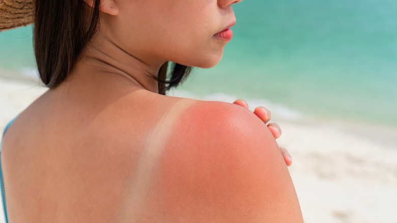 Woman with a sunburn 