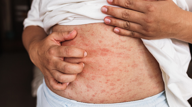 A person's stomach covered with an itchy, red rash.